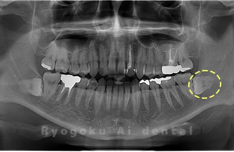 下顎左の親知らず