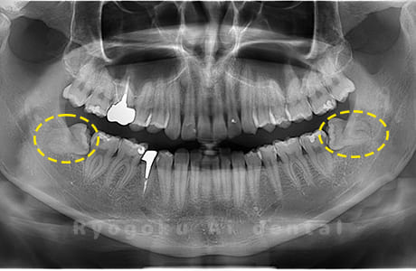 下顎左右の親知らず