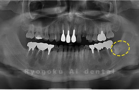 下顎左の親知らず