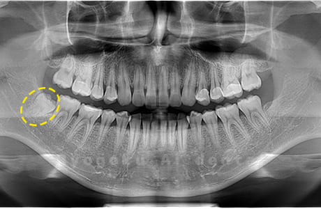 下顎右の親知らず