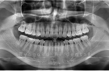 下顎右の親知らずを抜歯