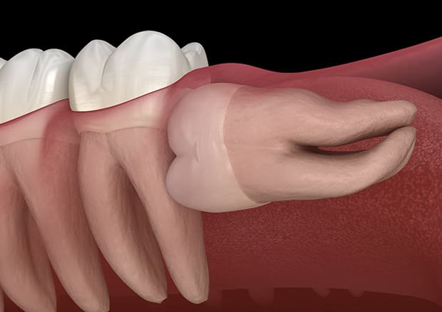 水平埋伏の親知らず